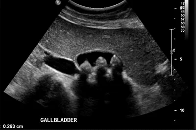 Cholelithiasis or Gallstones: A Very Common and Treatable Disease